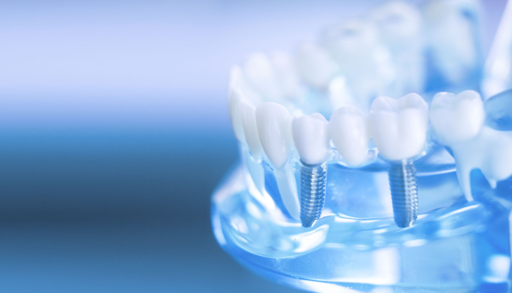 dental-implants-model – The Facial & Oral Surgery Center