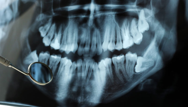 impacted-wisdom-tooth-xray – The Facial & Oral Surgery Center